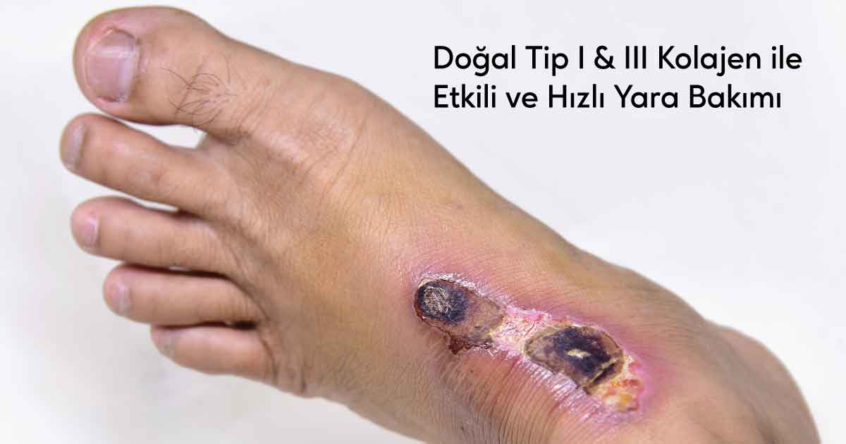 Ayak ülseri tedavisinde kullanılan doğal Tip I & III kollajen ile yara bakımı.