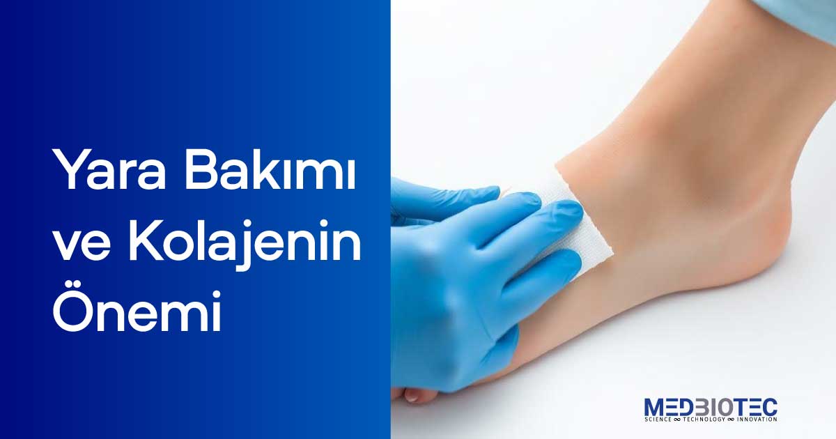 Bir hemşirenin mavi koruyucu eldivenlerle hastanın sağ ayağındaki yarayı kolajen ve hyaluronik asit ile dikkatlice tedavi ettiği yüksek çözünürlüklü yakın çekim bir fotoğraf. Yara, steril bir kompres veya bandajla kapatılmış olup, hijyenik ve profesyonel bir tedavi süreci vurgulanıyor. Arka plan, temiz ve aydınlık bir tıbbi ortamı yansıtıyor.